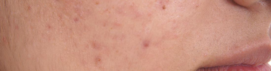 Hormonal Acne Diet: What to Eat and Avoid