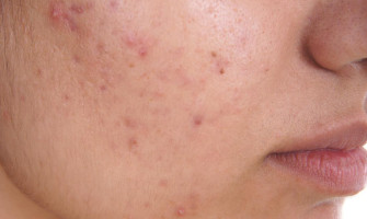 Hormonal Acne Diet: What to Eat and Avoid