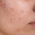 Hormonal Acne Diet: What to Eat and Avoid